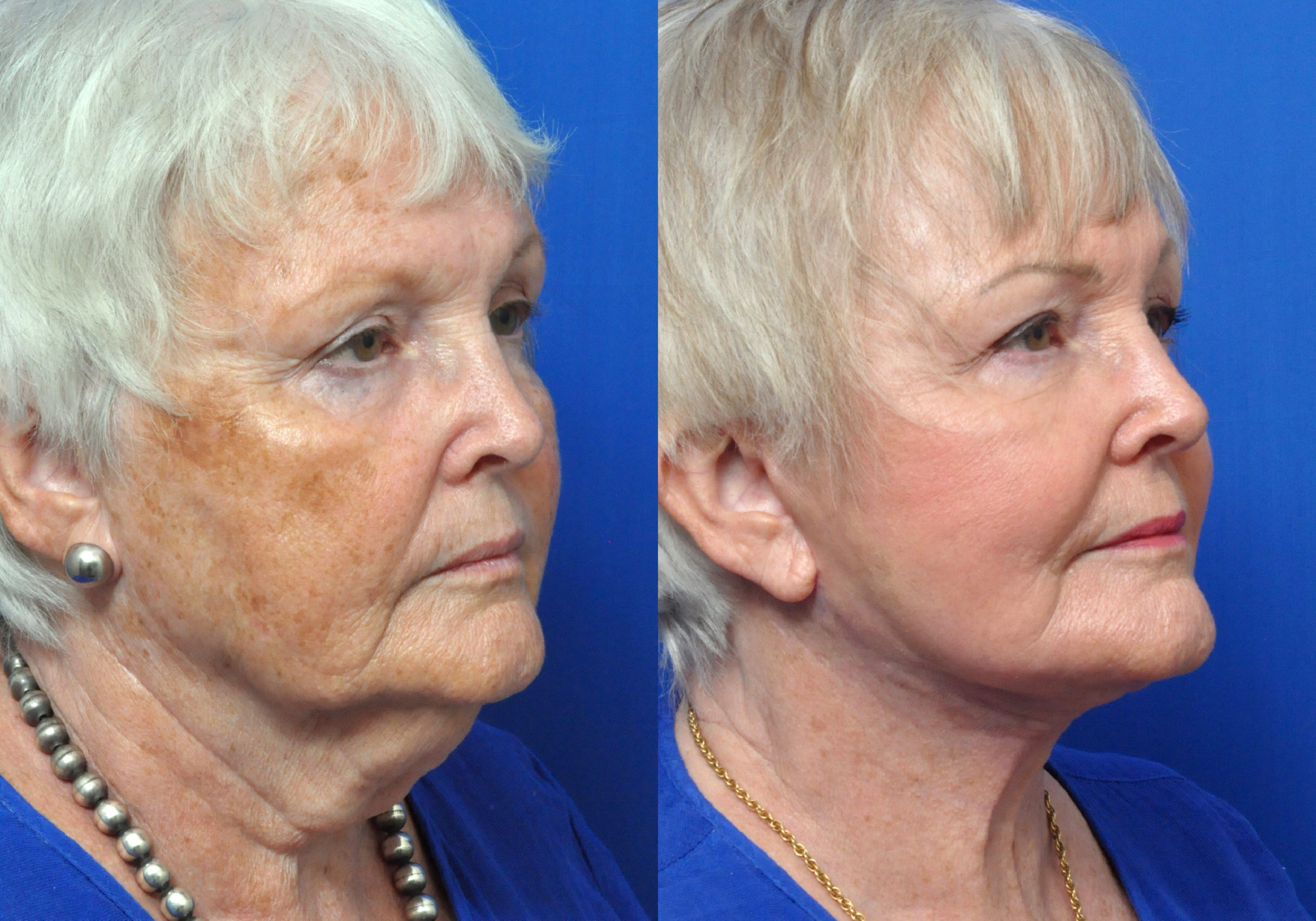 Facelift Journeys - Garcia Facial Plastic Surgery