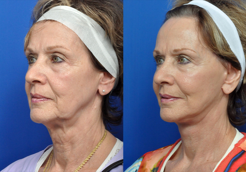 Neck Lift Journeys - Garcia Facial Plastic Surgery