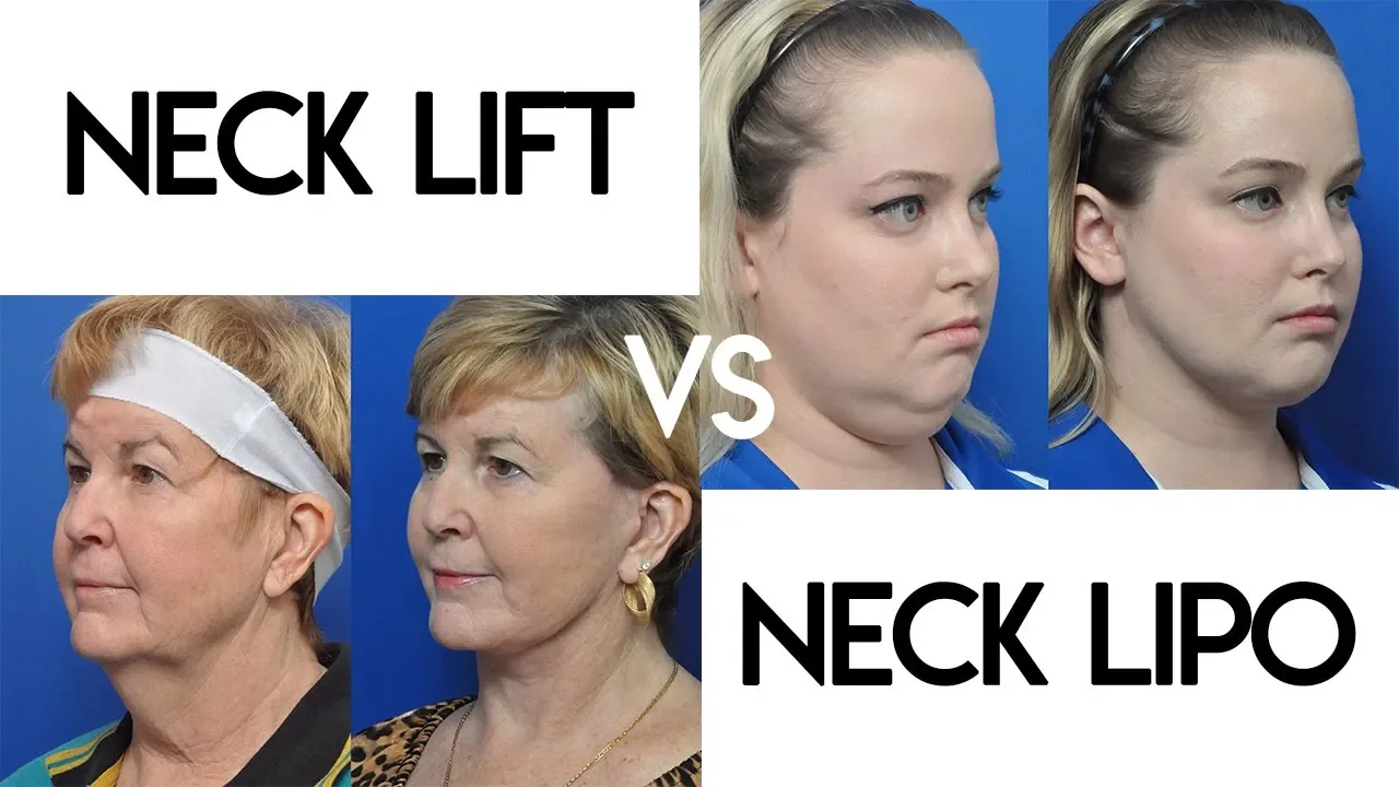 Neck Lift vs Neck Lipo