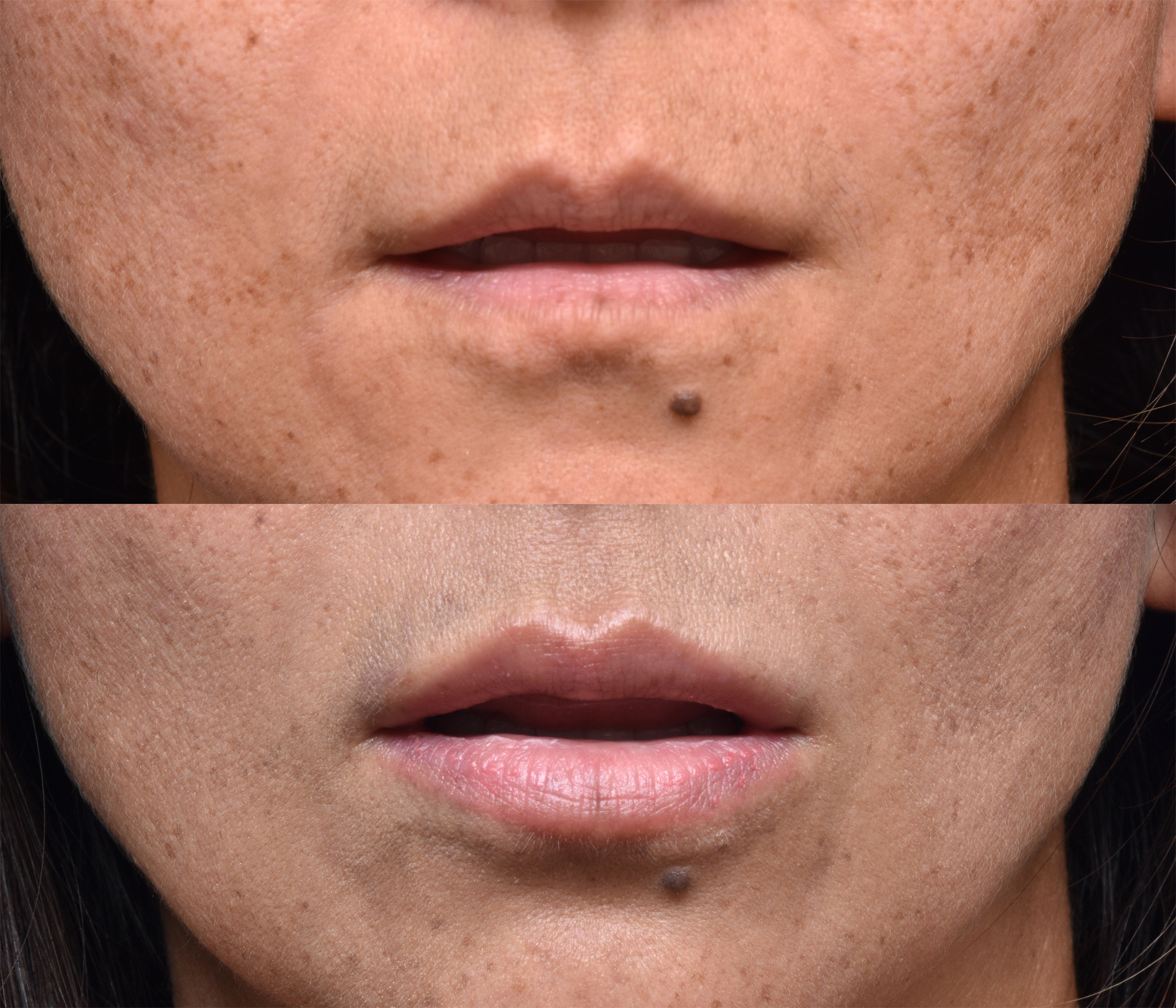 This patient received Lip Implants.