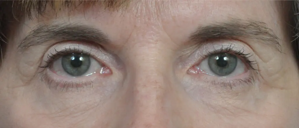 Plastic Surgery Before and After Pictures in Jacksonville, FL - Garcia Facial Plastic Surgery