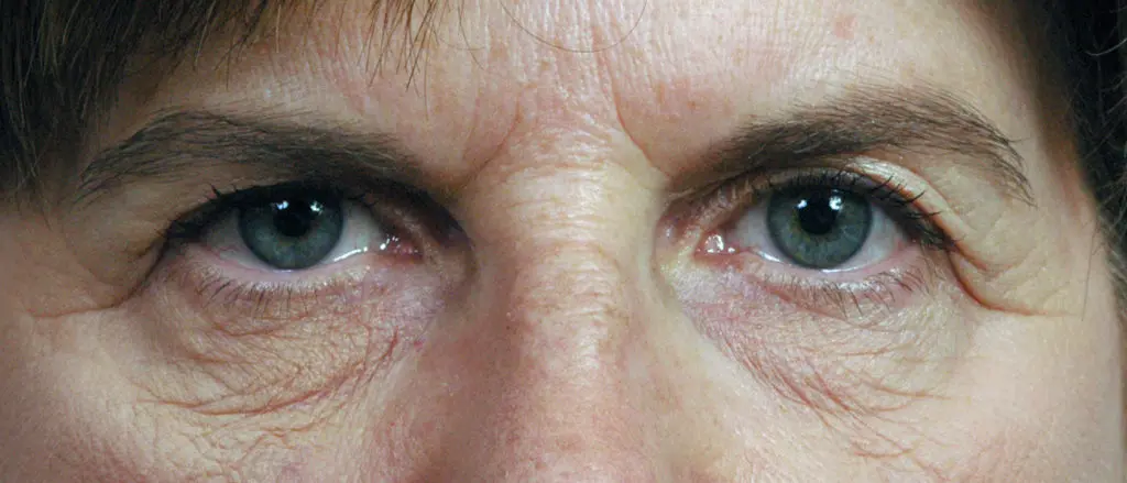 Plastic Surgery Before and After Pictures in Jacksonville, FL - Garcia Facial Plastic Surgery