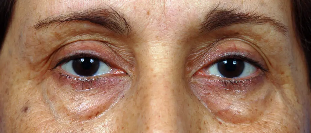 Plastic Surgery Before and After Pictures in Jacksonville, FL - Garcia Facial Plastic Surgery