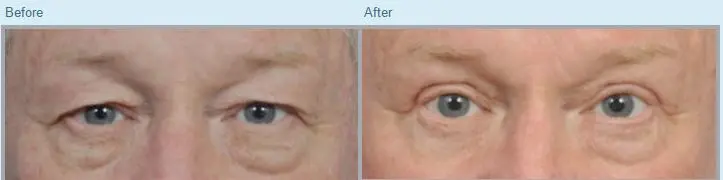 Blepharoplasty Before and After Pictures Jacksonville, FL