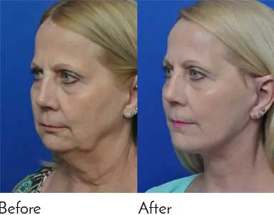Testimonials - Garcia Facial Plastic Surgery