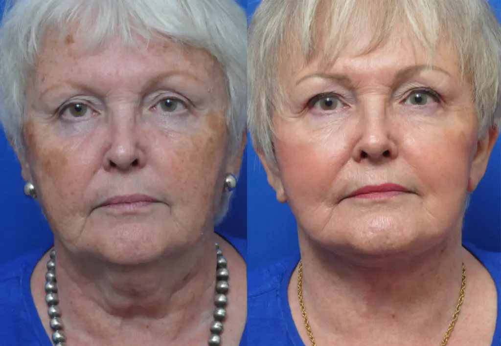 Chemical Peels in Jacksonville, FL