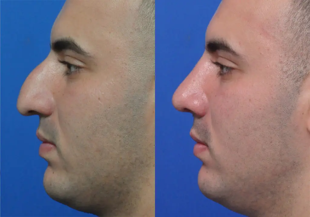 Male Rhinoplasty in Jacksonville, FL