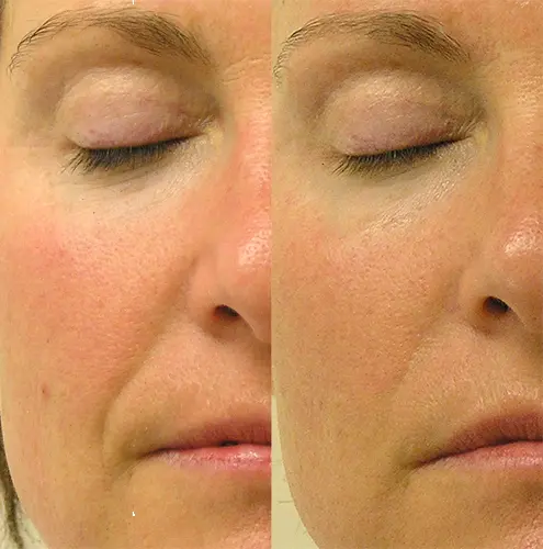 HydraFacialโข in Jacksonville, FL