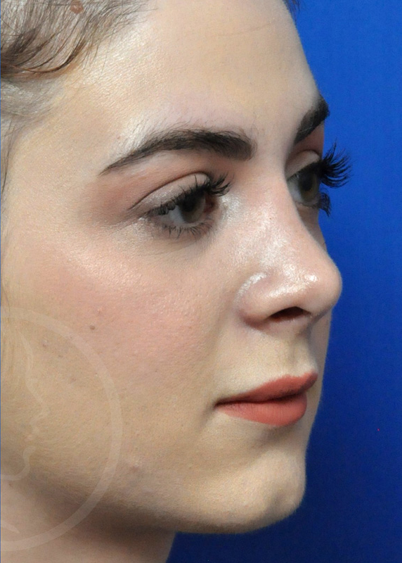 Plastic Surgery Before and After Pictures in Jacksonville, FL - Garcia Facial Plastic Surgery