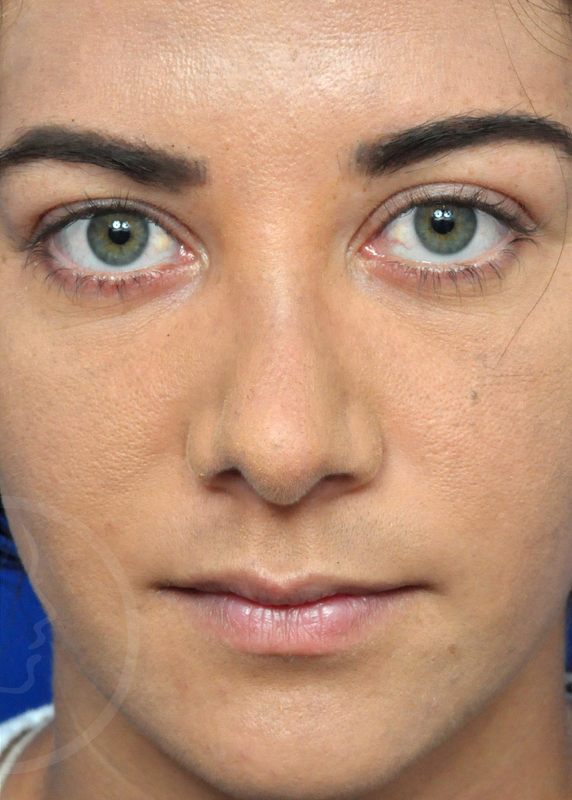 Plastic Surgery Before and After Pictures in Jacksonville, FL - Garcia Facial Plastic Surgery