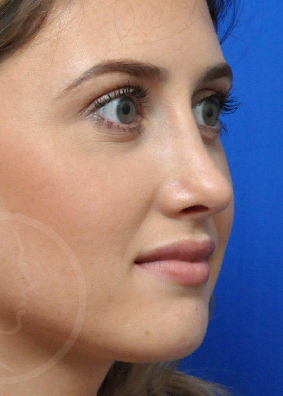 Plastic Surgery Before and After Pictures in Jacksonville, FL - Garcia Facial Plastic Surgery