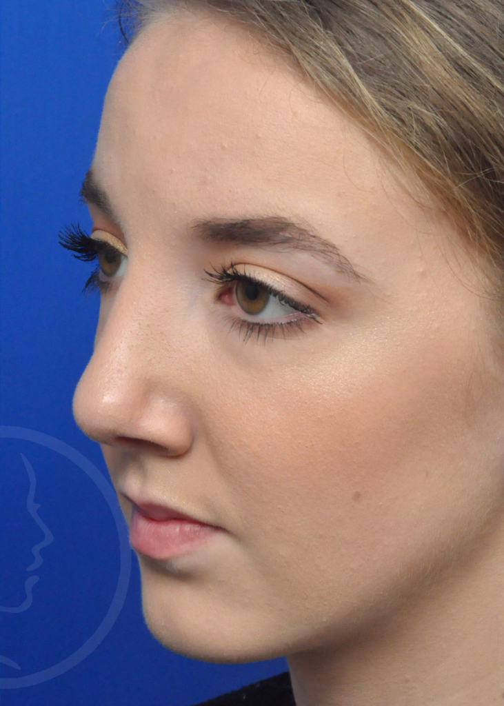 Plastic Surgery Before and After Pictures in Jacksonville, FL - Garcia Facial Plastic Surgery