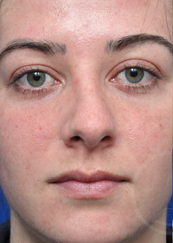 Plastic Surgery Before and After Pictures in Jacksonville, FL - Garcia Facial Plastic Surgery