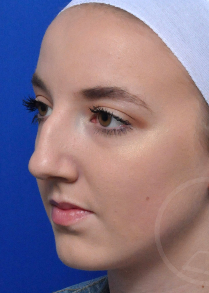 Plastic Surgery Before and After Pictures in Jacksonville, FL - Garcia Facial Plastic Surgery