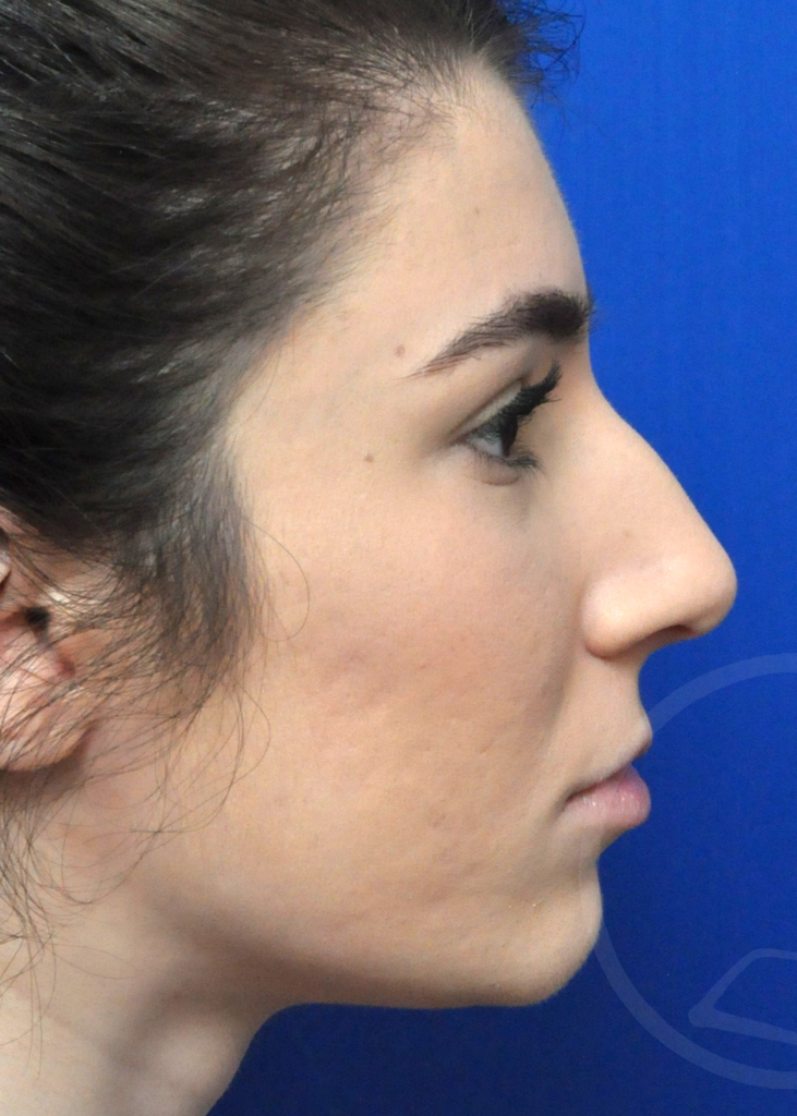 Plastic Surgery Before and After Pictures in Jacksonville, FL - Garcia Facial Plastic Surgery