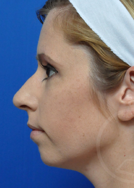 Plastic Surgery Before and After Pictures in Jacksonville, FL - Garcia Facial Plastic Surgery