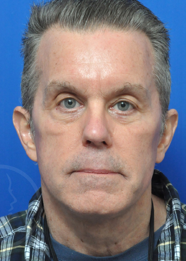 Plastic Surgery Before and After Pictures in Jacksonville, FL - Garcia Facial Plastic Surgery