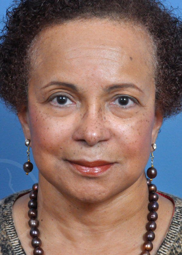 Plastic Surgery Before and After Pictures in Jacksonville, FL - Garcia Facial Plastic Surgery