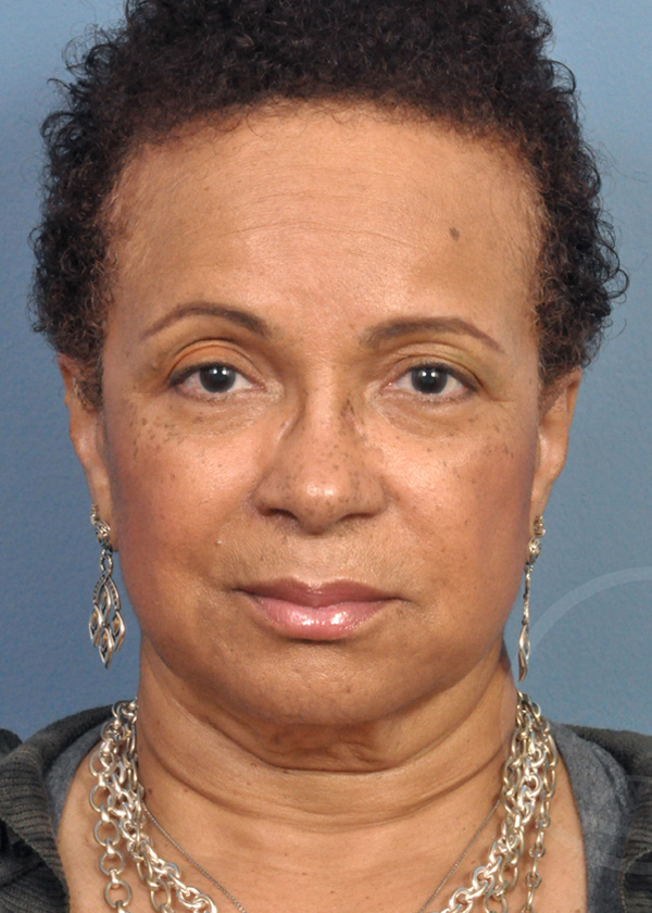 Plastic Surgery Before and After Pictures in Jacksonville, FL - Garcia Facial Plastic Surgery