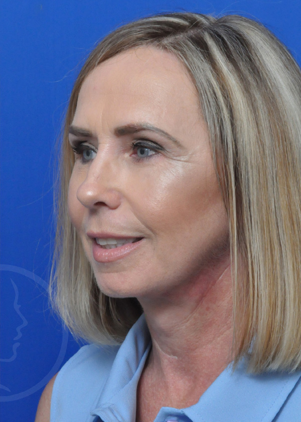 Plastic Surgery Before and After Pictures in Jacksonville, FL - Garcia Facial Plastic Surgery