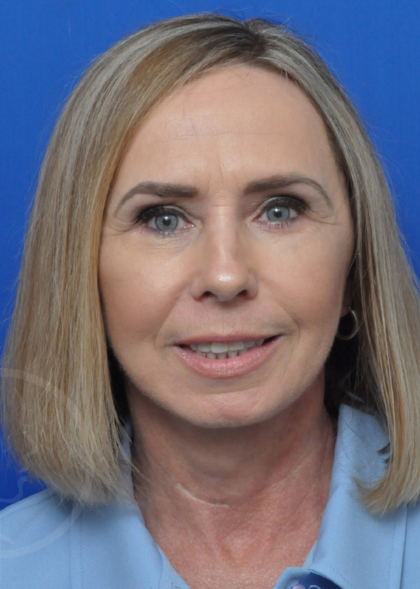 Plastic Surgery Before and After Pictures in Jacksonville, FL - Garcia Facial Plastic Surgery