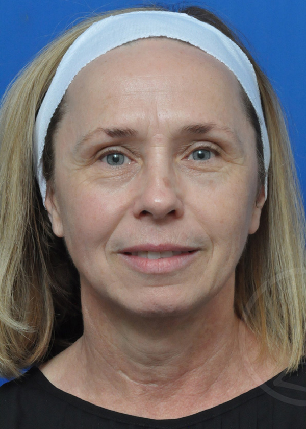 Plastic Surgery Before and After Pictures in Jacksonville, FL - Garcia Facial Plastic Surgery