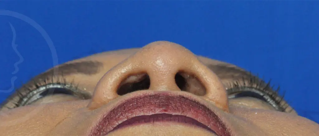 Plastic Surgery Before and After Pictures in Jacksonville, FL - Garcia Facial Plastic Surgery