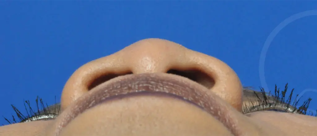 Plastic Surgery Before and After Pictures in Jacksonville, FL - Garcia Facial Plastic Surgery