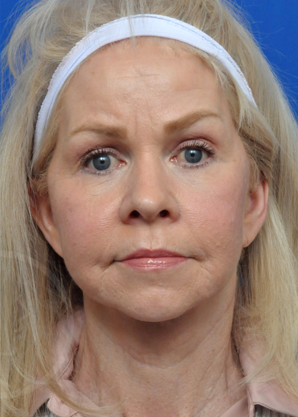 Plastic Surgery Before and After Pictures in Jacksonville, FL - Garcia Facial Plastic Surgery