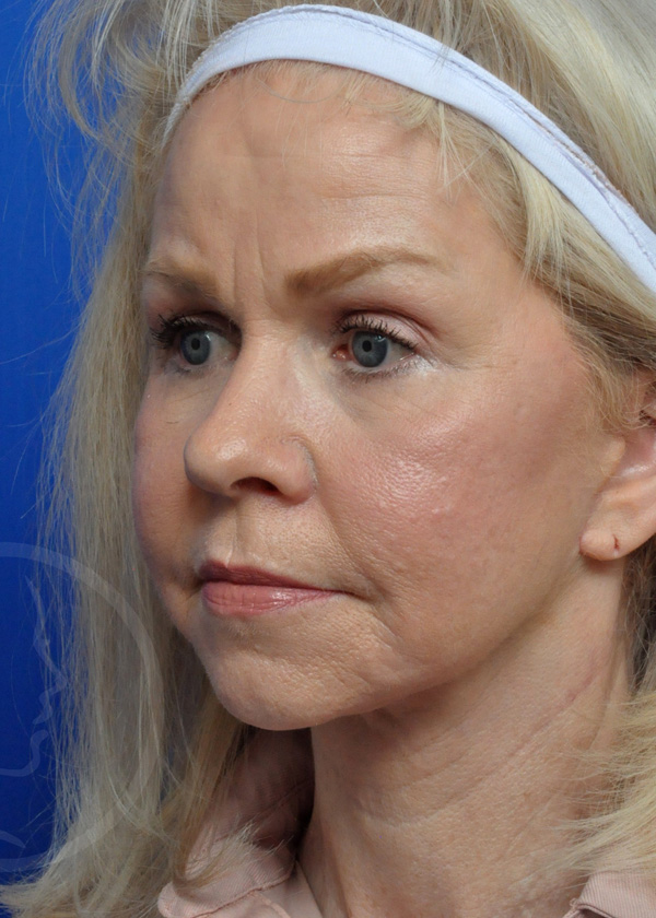 Plastic Surgery Before and After Pictures in Jacksonville, FL - Garcia Facial Plastic Surgery