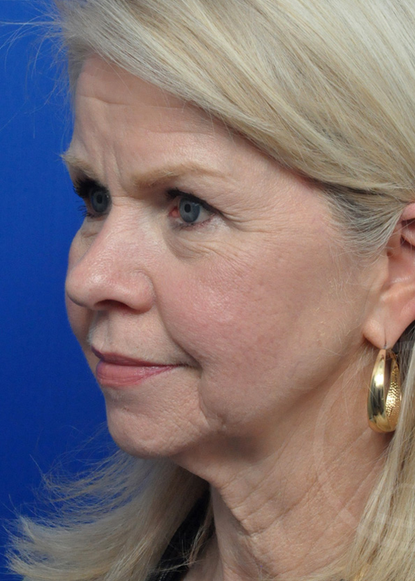 Plastic Surgery Before and After Pictures in Jacksonville, FL - Garcia Facial Plastic Surgery