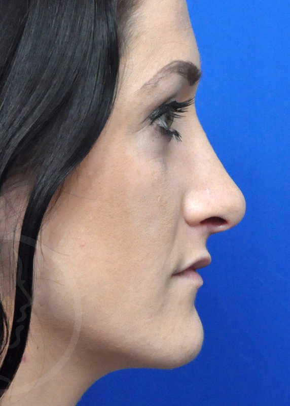 Plastic Surgery Before and After Pictures in Jacksonville, FL - Garcia Facial Plastic Surgery