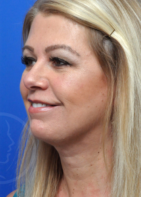 Plastic Surgery Before and After Pictures in Jacksonville, FL - Garcia Facial Plastic Surgery