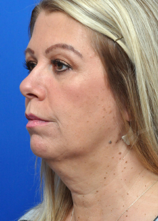 Plastic Surgery Before and After Pictures in Jacksonville, FL - Garcia Facial Plastic Surgery