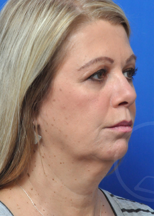 Plastic Surgery Before and After Pictures in Jacksonville, FL - Garcia Facial Plastic Surgery