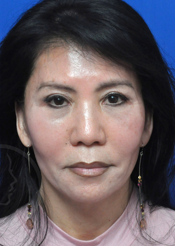 Plastic Surgery Before and After Pictures in Jacksonville, FL - Garcia Facial Plastic Surgery