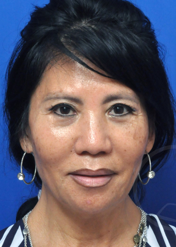 Plastic Surgery Before and After Pictures in Jacksonville, FL - Garcia Facial Plastic Surgery