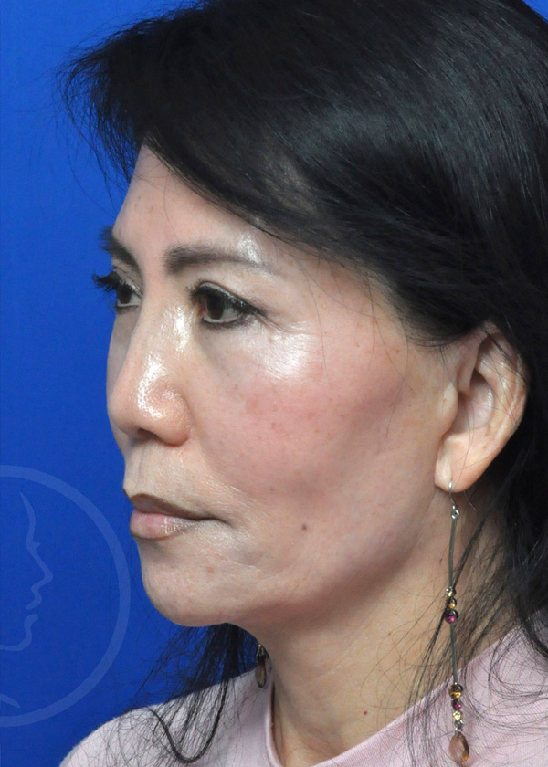 Plastic Surgery Before and After Pictures in Jacksonville, FL - Garcia Facial Plastic Surgery