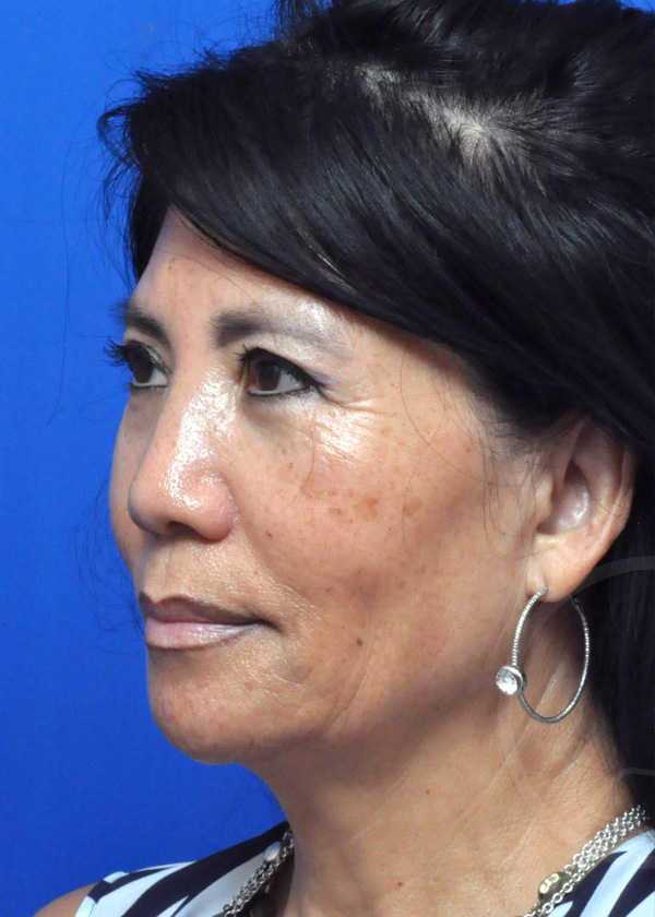 Plastic Surgery Before and After Pictures in Jacksonville, FL - Garcia Facial Plastic Surgery