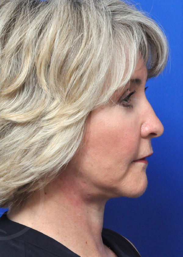 Plastic Surgery Before and After Pictures in Jacksonville, FL - Garcia Facial Plastic Surgery