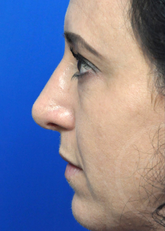 Plastic Surgery Before and After Pictures in Jacksonville, FL - Garcia Facial Plastic Surgery