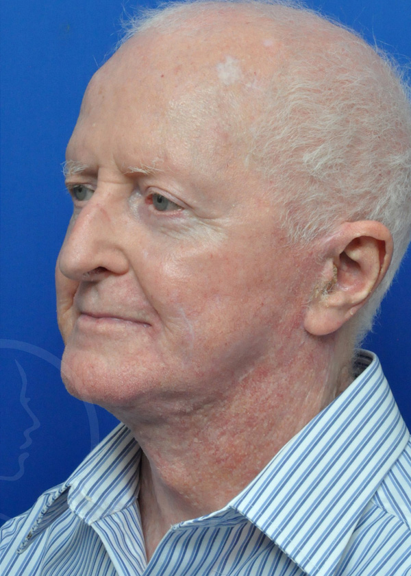 Plastic Surgery Before and After Pictures in Jacksonville, FL - Garcia Facial Plastic Surgery