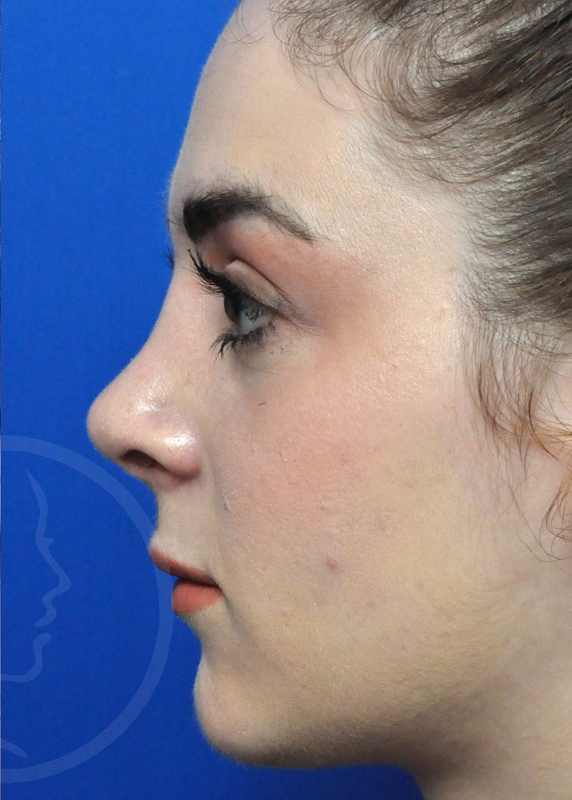 Plastic Surgery Before and After Pictures in Jacksonville, FL - Garcia Facial Plastic Surgery