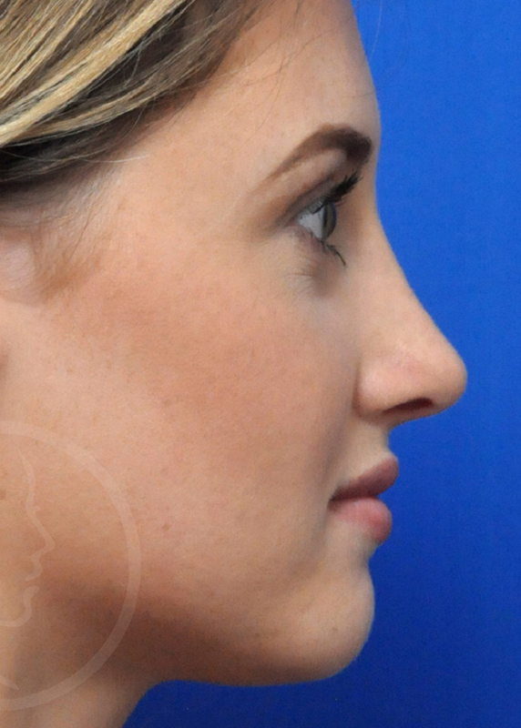 Plastic Surgery Before and After Pictures in Jacksonville, FL - Garcia Facial Plastic Surgery