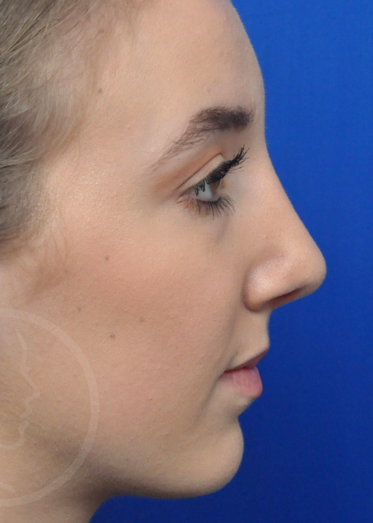 Plastic Surgery Before and After Pictures in Jacksonville, FL - Garcia Facial Plastic Surgery