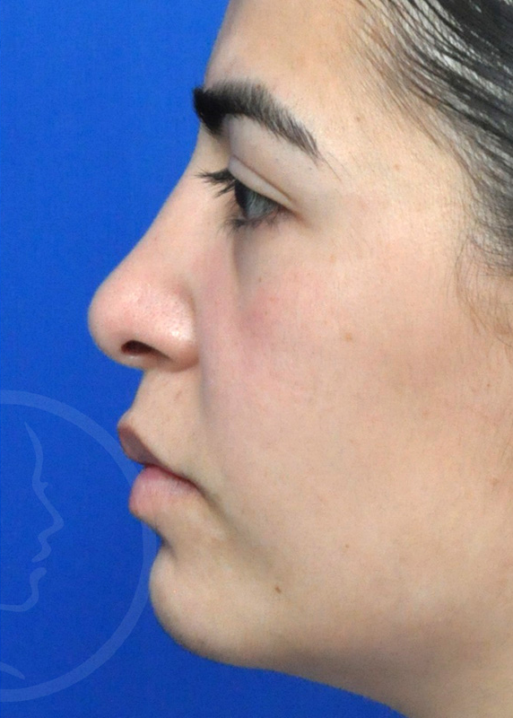 Plastic Surgery Before and After Pictures in Jacksonville, FL - Garcia Facial Plastic Surgery