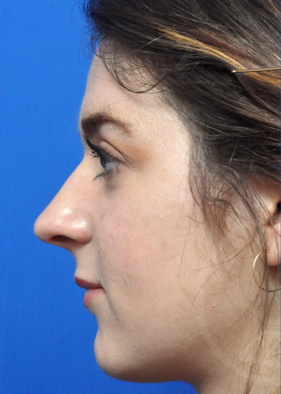 Plastic Surgery Before and After Pictures in Jacksonville, FL - Garcia Facial Plastic Surgery