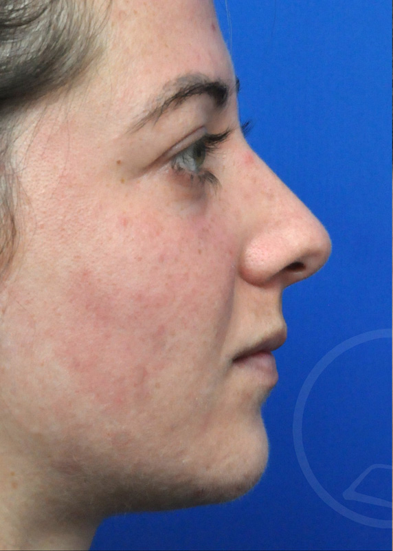 Plastic Surgery Before and After Pictures in Jacksonville, FL - Garcia Facial Plastic Surgery