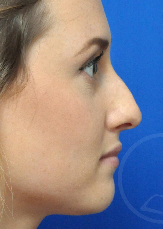 Plastic Surgery Before and After Pictures in Jacksonville, FL - Garcia Facial Plastic Surgery