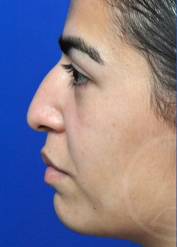 Plastic Surgery Before and After Pictures in Jacksonville, FL - Garcia Facial Plastic Surgery